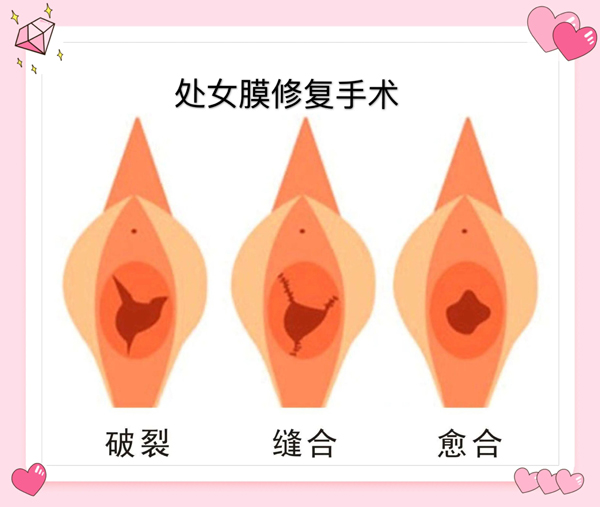 处女膜修复手术.jpg