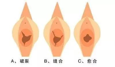 处女膜修复后效果图.jpg