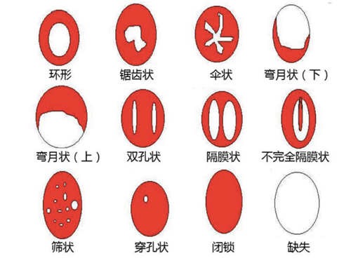 处女膜形状.jpg