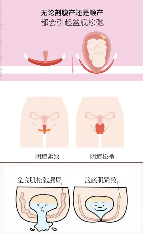 深圳千氧私密整形：漏尿、私密抗衰关乎健康、家庭.jpg