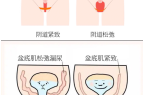 深圳千氧私密整形：漏尿、私密抗衰关乎健康