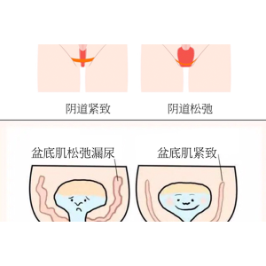 深圳千氧私密整形：漏尿、私密抗衰关乎健康、家庭